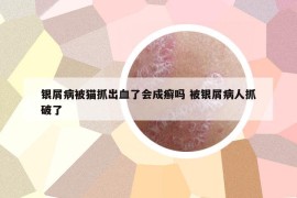 銀屑病被貓抓出血了會(huì)成癬嗎 被銀屑病人抓破了