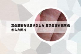 耳朵里面有銀屑病怎么辦 耳朵里面有銀屑病怎么辦圖片