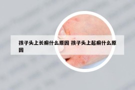 孩子頭上長(zhǎng)癬什么原因 孩子頭上起癬什么原因