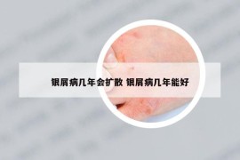 銀屑病幾年會(huì)擴(kuò)散 銀屑病幾年能好