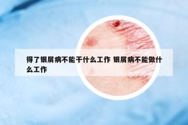 得了銀屑病不能干什么工作 銀屑病不能做什么工作
