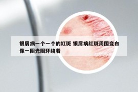 銀屑病一個一個的紅斑 銀屑病紅斑周圍變白像一圈光圈環(huán)繞著