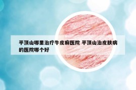 平頂山哪里治療牛皮癬醫(yī)院 平頂山治皮膚病的醫(yī)院哪個好