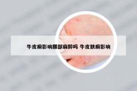 牛皮癬影響腰部麻醉嗎 牛皮膚癬影響