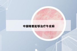 中國哪里能夠治療牛皮癬