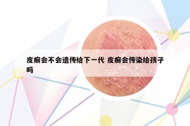 皮癬會(huì)不會(huì)遺傳給下一代 皮癬會(huì)傳染給孩子嗎