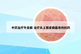 中藥治療牛皮癬 治療頭上銀皮癬最有效的藥