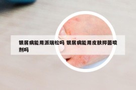 銀屑病能用派瑞松嗎 銀屑病能用皮膚抑菌噴劑嗎