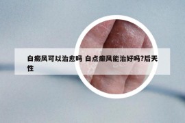 白癜風可以治愈嗎 白點癲風能治好嗎?后天性