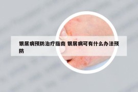 銀屑病預(yù)防治療指南 銀屑病可有什么辦法預(yù)防