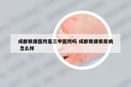成都銀康醫(yī)院是三甲醫(yī)院嗎 成都銀康銀屑病 怎么樣