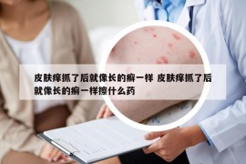 皮膚癢抓了后就像長的癬一樣 皮膚癢抓了后就像長的癬一樣擦什么藥