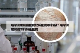 哈爾濱銀屑病醫(yī)院權威醫(yī)院哪家最好 哈爾濱銀屑病?？铺厣t(yī)院