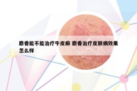 麝香能不能治療牛皮癬 麝香治療皮膚病效果怎么樣