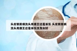 頭皮銀屑病洗頭用康王還是采樂 頭皮銀屑病洗頭用康王還是采樂洗發(fā)水好