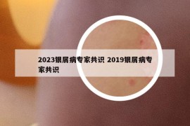 2023銀屑病專家共識(shí) 2019銀屑病專家共識(shí)