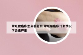 掌趾膿皰疹怎么引起的 掌趾膿皰疹什么情況下會更嚴(yán)重
