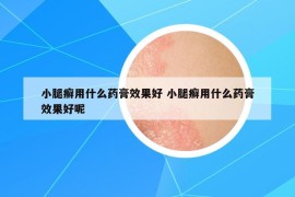 小腿癬用什么藥膏效果好 小腿癬用什么藥膏效果好呢