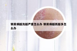 銀屑病越洗越嚴(yán)重怎么辦 銀屑病越抓越多怎么辦