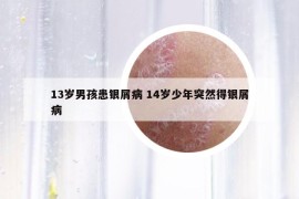 13歲男孩患銀屑病 14歲少年突然得銀屑病