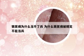銀屑病為什么當(dāng)不了兵 為什么銀屑病被規(guī)定不能當(dāng)兵