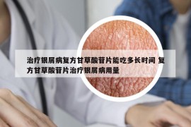 治療銀屑病復(fù)方甘草酸苷片能吃多長時間 復(fù)方甘草酸苷片治療銀屑病用量