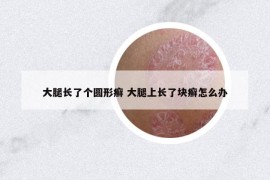大腿長(zhǎng)了個(gè)圓形癬 大腿上長(zhǎng)了塊癬怎么辦