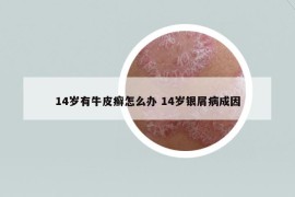 14歲有牛皮癬怎么辦 14歲銀屑病成因