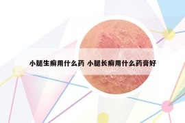 小腿生癬用什么藥 小腿長癬用什么藥膏好