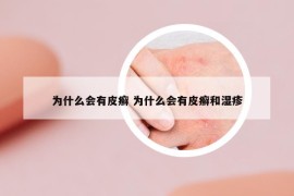 為什么會有皮癬 為什么會有皮癬和濕疹