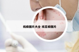 線癬圖片大全 線苔癬圖片