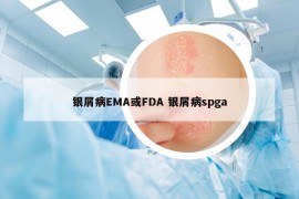 銀屑病EMA或FDA 銀屑病spga