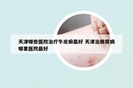 天津哪些醫(yī)院治療牛皮癬最好 天津治銀屑病哪里醫(yī)院最好