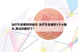 治療牛皮癬特效秘方 治療牛皮癬的3個(gè)小偏方,用過(guò)的都好了!