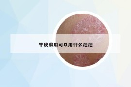 牛皮癬用可以用什么泡泡