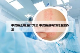 牛皮癬正確治療方法 牛皮癬最有效的治愈辦法