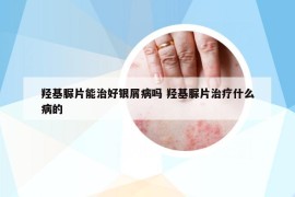 羥基脲片能治好銀屑病嗎 羥基脲片治療什么病的