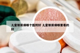 兒童銀屑病哪個醫(yī)院好 兒童銀屑病哪里看的好