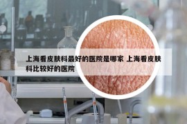 上?？雌つw科最好的醫(yī)院是哪家 上海看皮膚科比較好的醫(yī)院