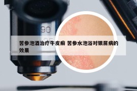 苦參泡酒治療牛皮癬 苦參水泡浴對銀屑病的效果