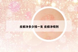 皮癬凈多少錢(qián)一支 皮癬凈噴劑