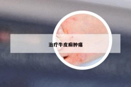 治療牛皮癬腫痛