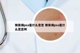 銀屑病psa是什么意思 銀屑病psa是什么意思啊
