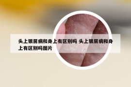 頭上銀屑病和身上有區(qū)別嗎 頭上銀屑病和身上有區(qū)別嗎圖片
