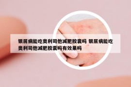銀屑病能吃奧利司他減肥膠囊嗎 銀屑病能吃奧利司他減肥膠囊嗎有效果嗎