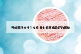 開封醫(yī)院治療牛皮癬 開封銀屑病最好的醫(yī)院