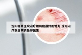 沈陽哪家醫(yī)院治療銀屑病最好的地方 沈陽治療銀屑病的最好醫(yī)生