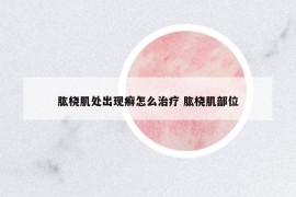 肱橈肌處出現(xiàn)癬怎么治療 肱橈肌部位