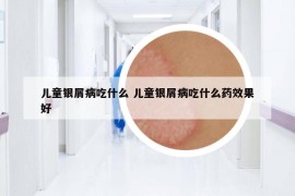 兒童銀屑病吃什么 兒童銀屑病吃什么藥效果好