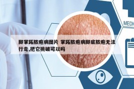 腳掌跖膿皰病圖片 掌跖膿皰病腳底膿皰無法行走,把它挑破可以嗎